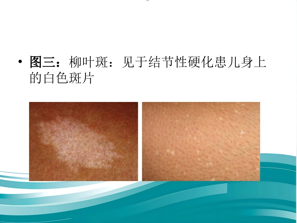 儿科常见皮疹识别_第10页