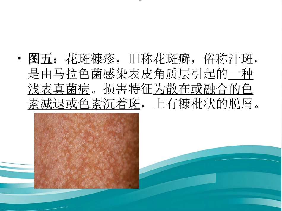 儿科常见皮疹识别_第12页