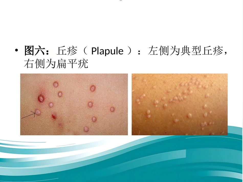 儿科常见皮疹识别_第14页