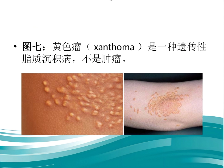 儿科常见皮疹识别_第15页