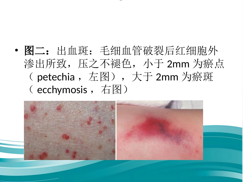 儿科常见皮疹识别_第9页