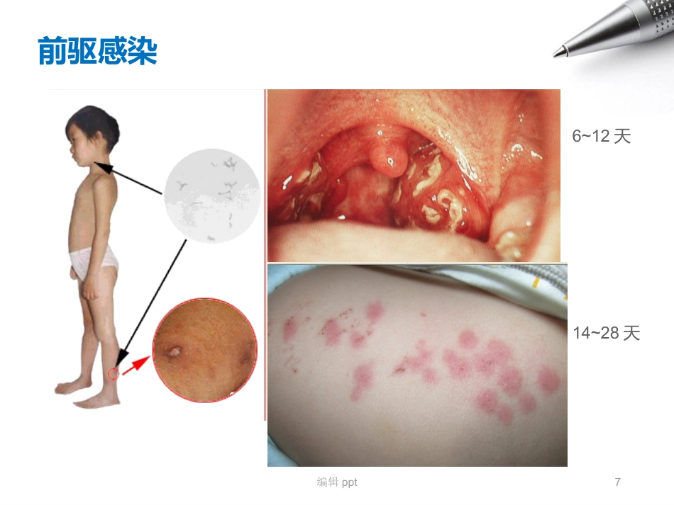 儿科护理急性肾小球肾炎_第7页
