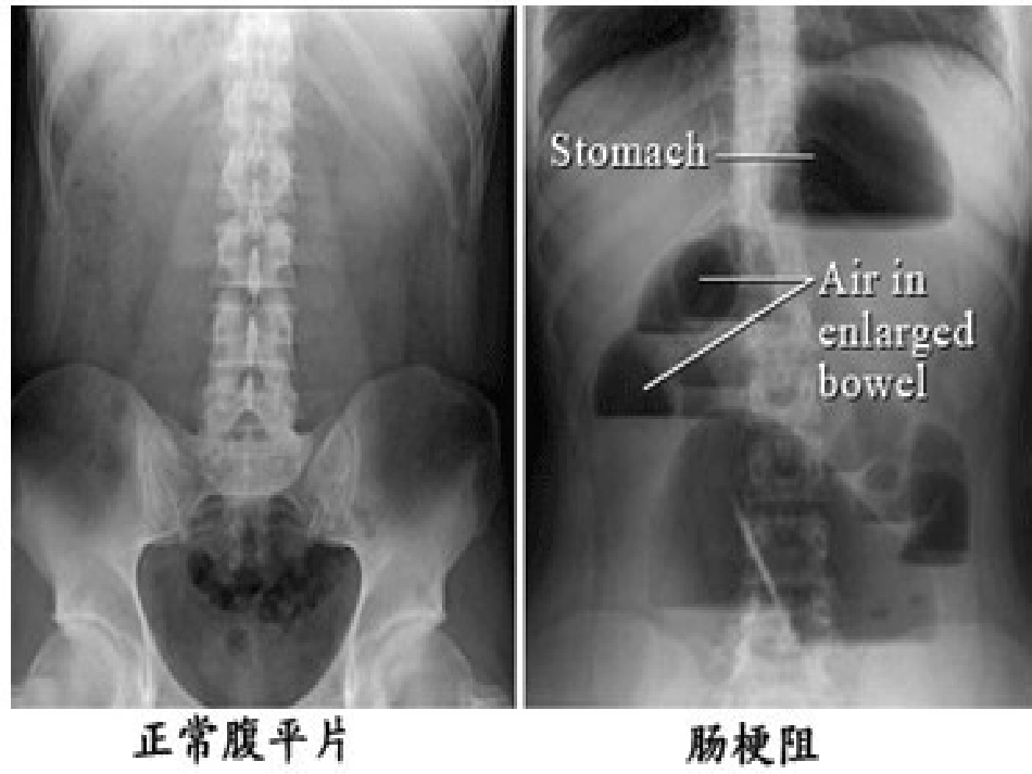 儿科腹痛-PPT课件_第13页