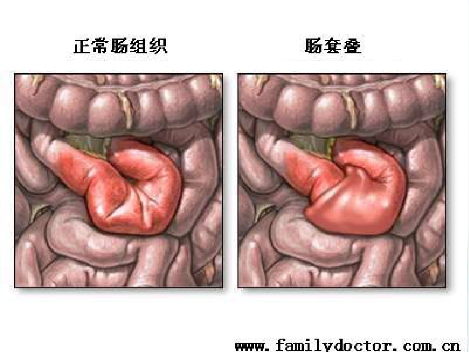 儿科腹痛-PPT课件_第7页