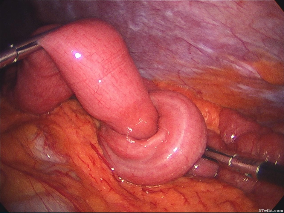 儿科腹痛-PPT课件_第8页