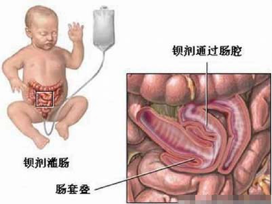 儿科腹痛-PPT课件_第9页