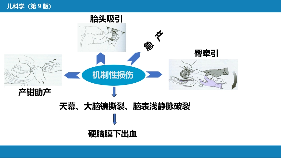 第六章 新生儿与新生儿疾病 第六节 新生儿颅内出血_第11页