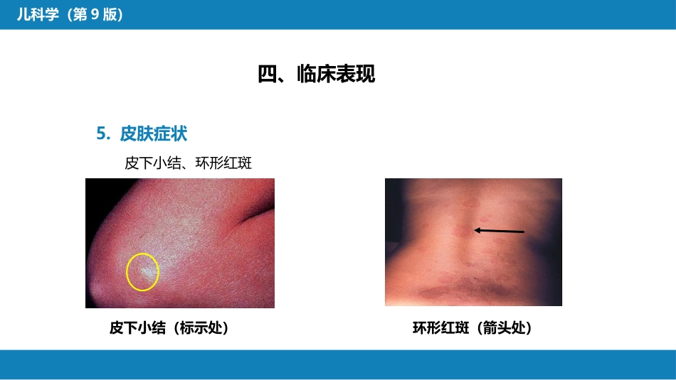 第七章 免疫性疾病 第四节-第八节_第15页