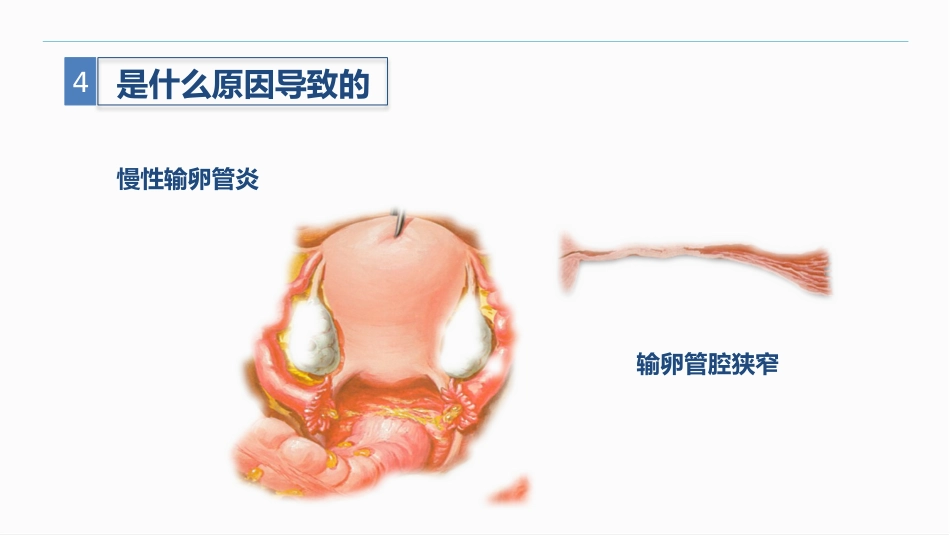 异位妊娠_第15页
