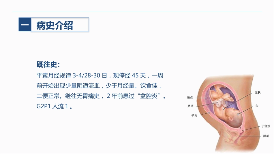 异位妊娠_第4页