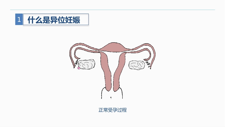 异位妊娠_第8页
