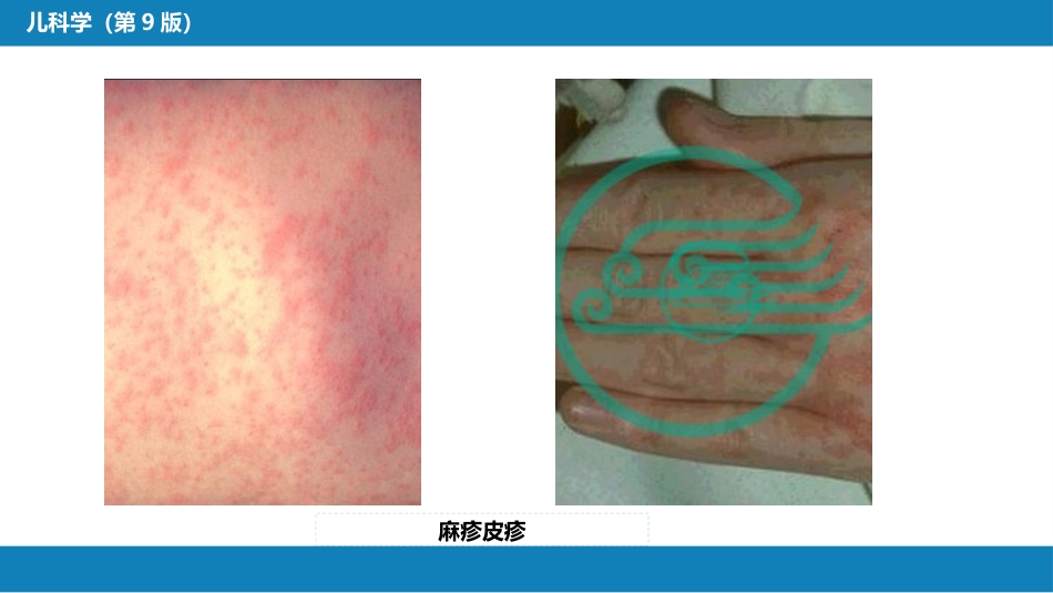 第八章 感染性疾病 第一节 病毒感染_第15页