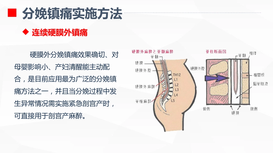 无痛分娩的护理业务学习_第14页