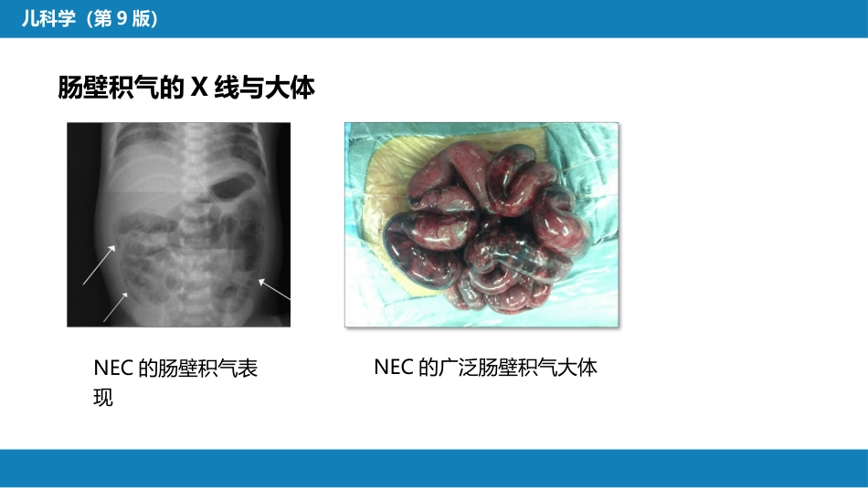 第六章 新生儿与新生儿疾病 第十二节 新生儿坏死性小肠结肠炎_第10页
