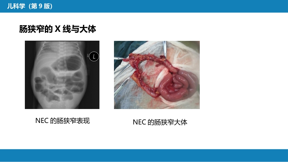 第六章 新生儿与新生儿疾病 第十二节 新生儿坏死性小肠结肠炎_第11页