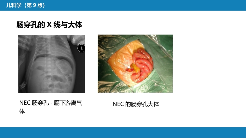 第六章 新生儿与新生儿疾病 第十二节 新生儿坏死性小肠结肠炎_第12页