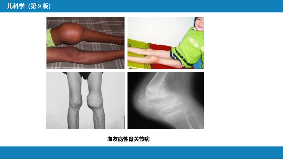 第十三章 造血系统疾病 第五节-第八节_第12页