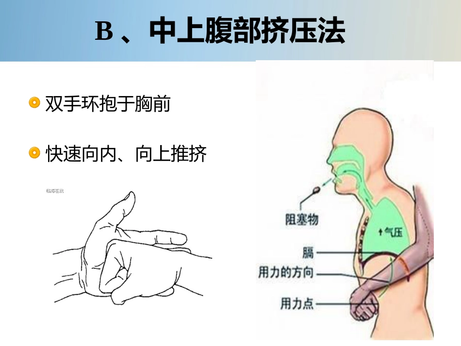 精神科护理技能 5.4 噎食防范与护理_第13页