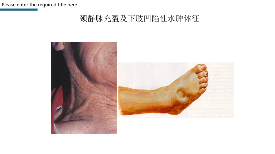 心力衰竭护理查房PPT模板_第14页