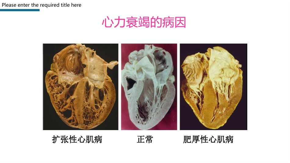 心力衰竭护理查房PPT模板_第7页