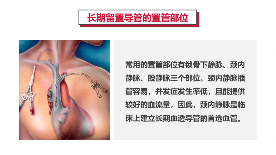 血液透析留置导管护理_第7页