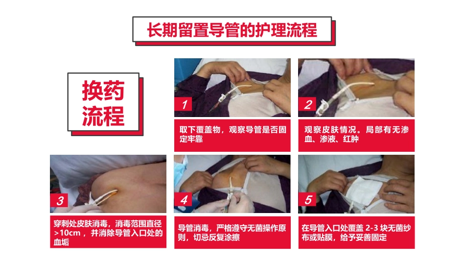 血液透析留置导管护理_第9页