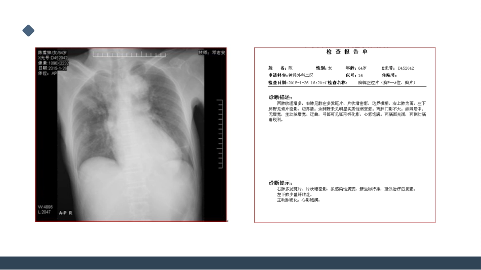 一例桥脑出血的护理个案分享_第11页