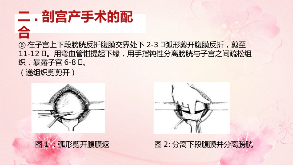 剖宫产手术护理查房_第13页