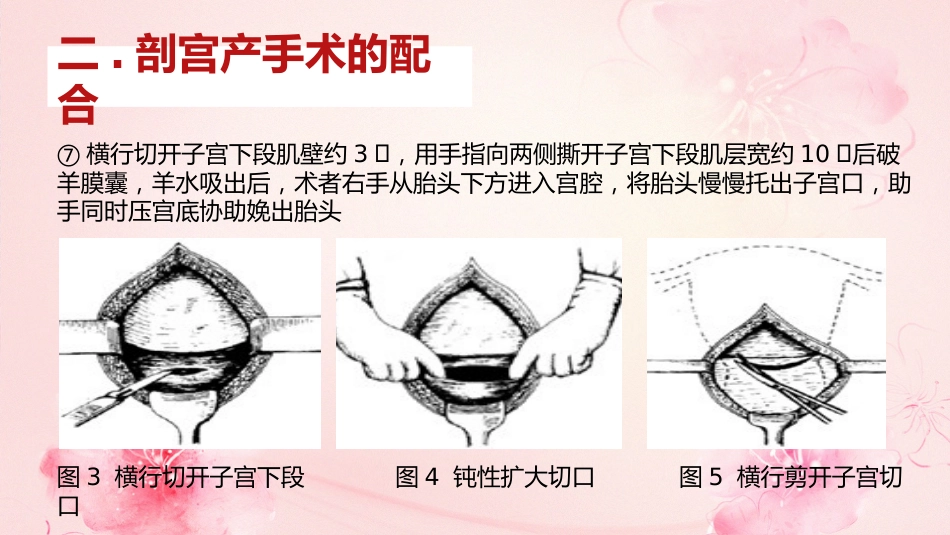 剖宫产手术护理查房_第14页