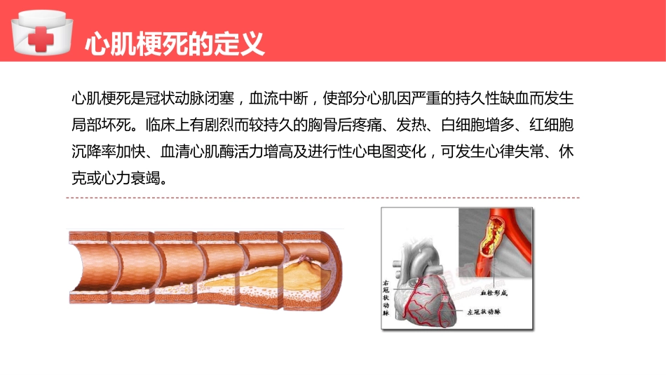 心肌梗塞个案护理（1）_第7页