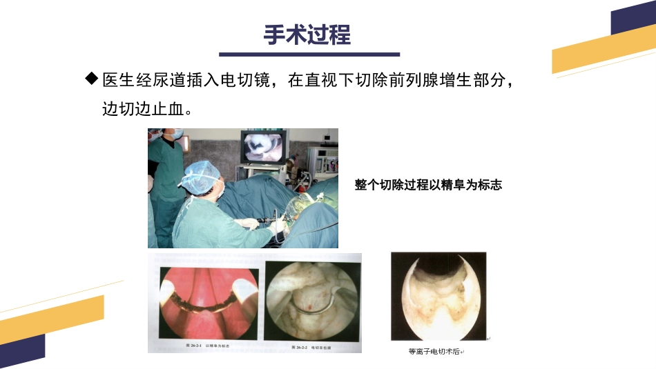 经尿道前列腺电切手术配合_第14页