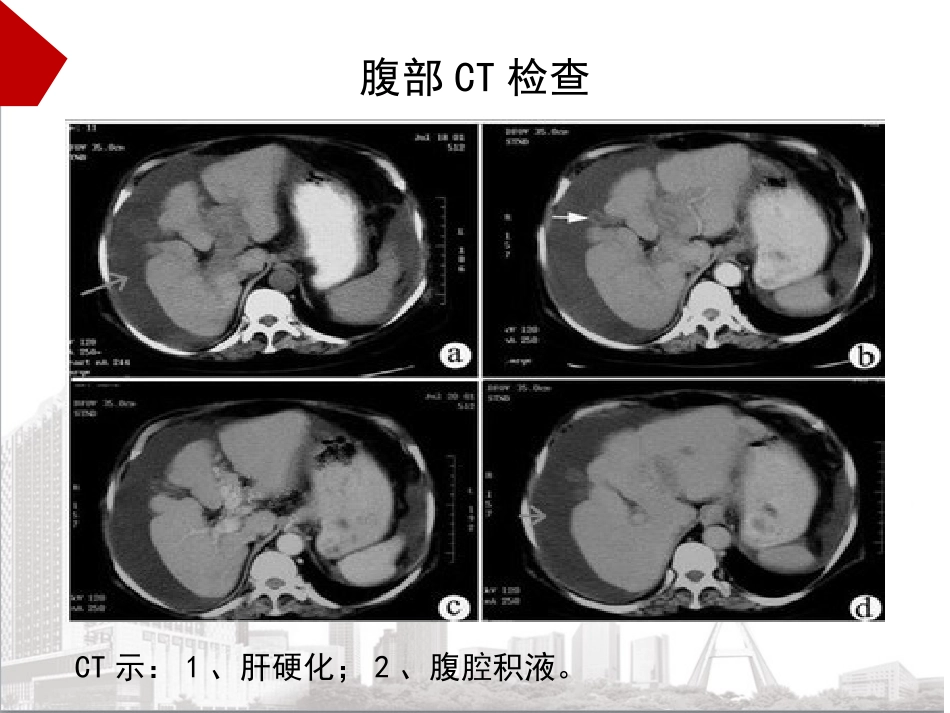 腹腔穿刺术教学_第5页