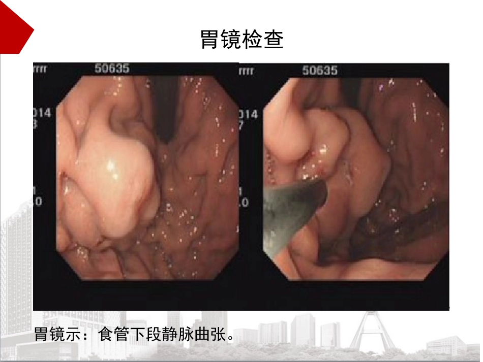 腹腔穿刺术教学_第6页