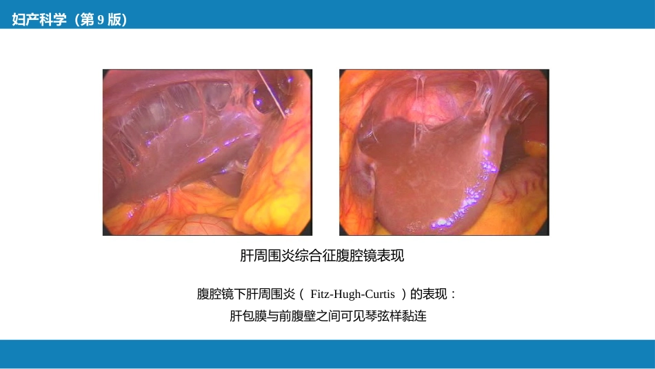 盆腔炎性疾病及生殖器结核_第15页