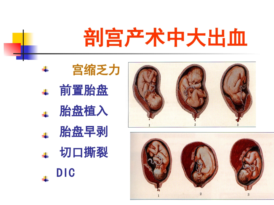 、分娩并发症--产后出血、子宫破裂_第12页