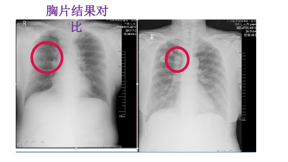 一例哮喘合并肺癌患者的个案_第13页