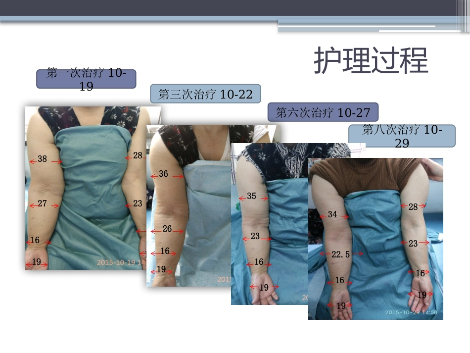 淋巴水肿的护理体会_第12页