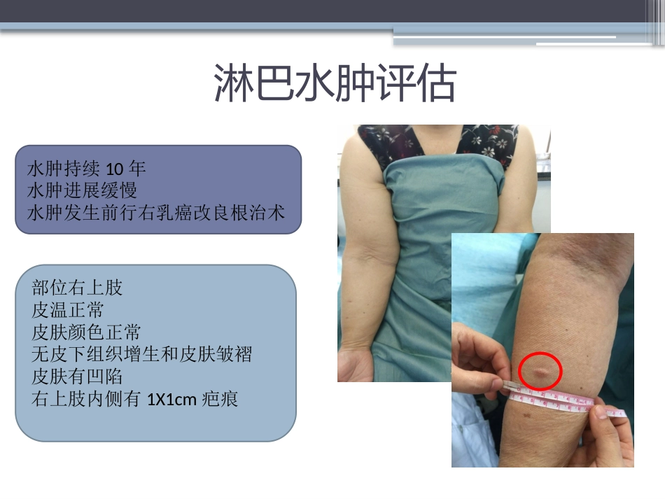 淋巴水肿的护理体会_第5页