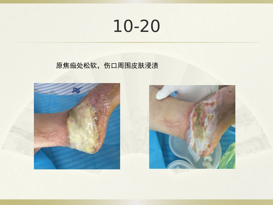 一例糖尿病合并足部外伤患者的护理_第12页