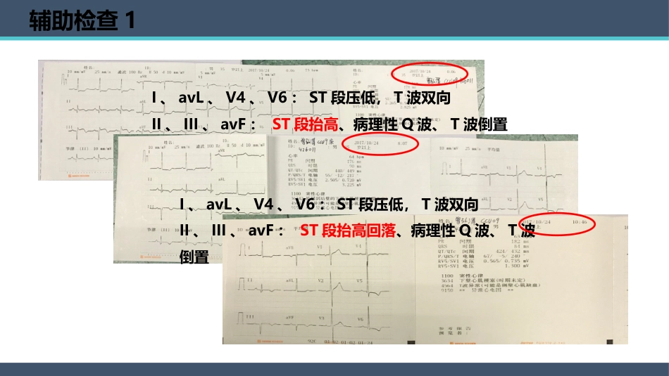 一例PCI术后老年患者心脏康复的个案护理_第13页