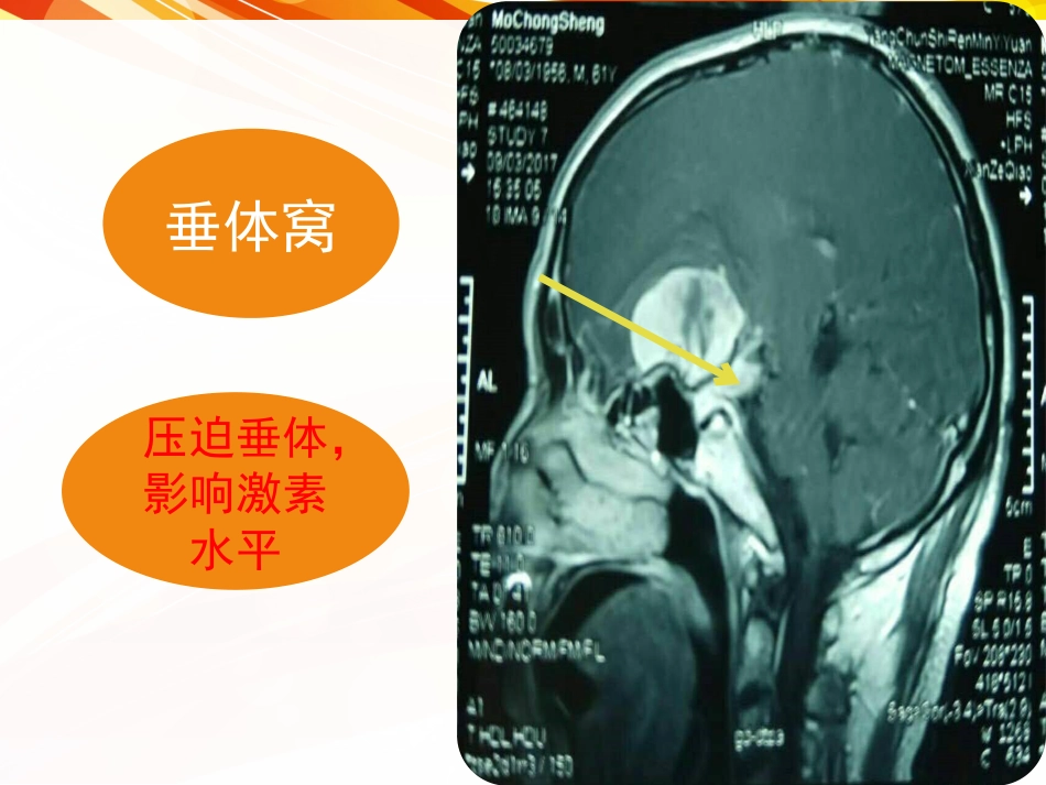 一例肿瘤卒中患者的护理_第10页