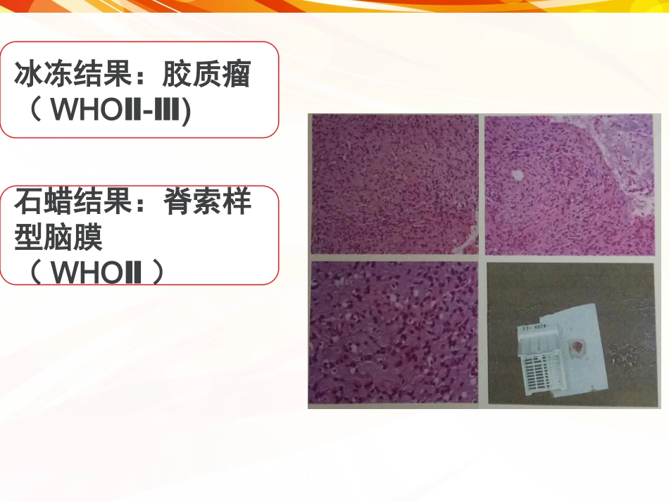 一例肿瘤卒中患者的护理_第11页