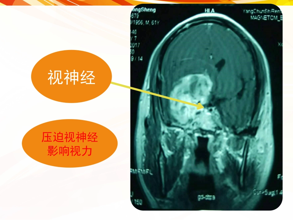 一例肿瘤卒中患者的护理_第9页