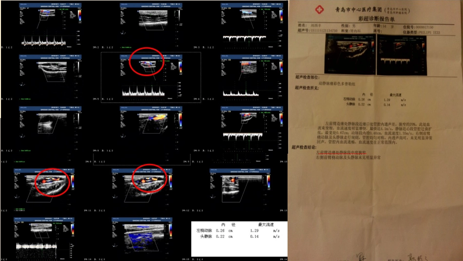 高位内瘘患者个案护理_第10页
