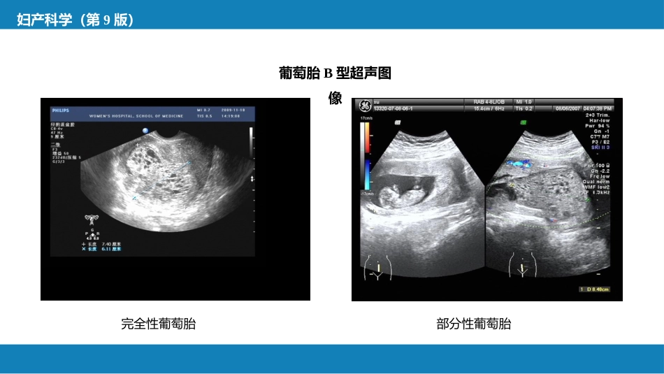 妊娠滋养细胞疾病_第13页