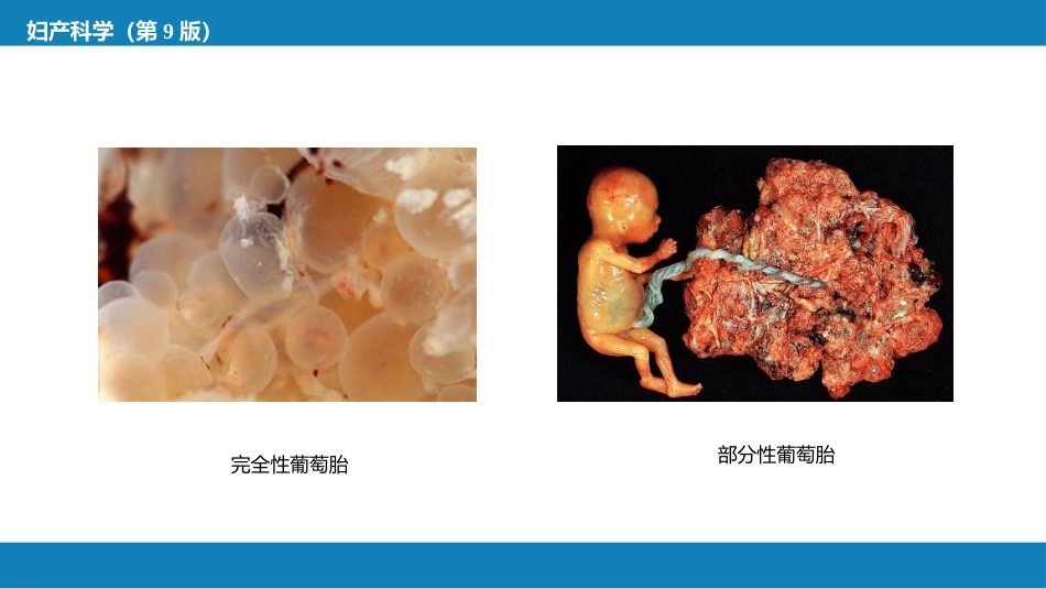 妊娠滋养细胞疾病_第7页