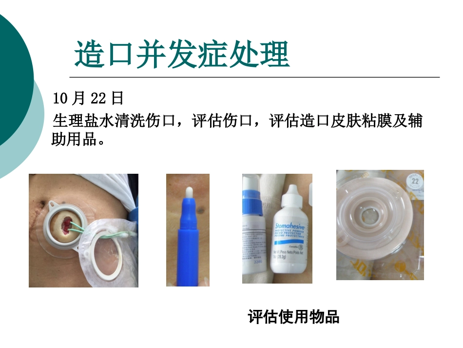 一例输尿管皮肤造口并发刺激性皮炎患者的护理_第10页