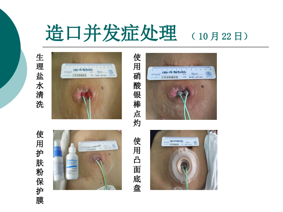 一例输尿管皮肤造口并发刺激性皮炎患者的护理_第11页