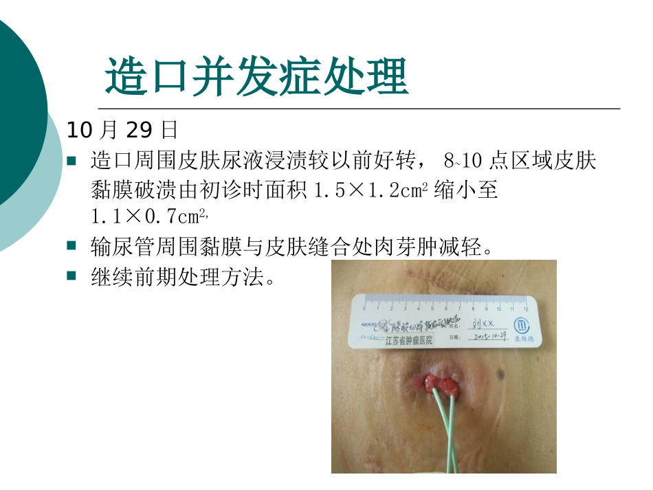 一例输尿管皮肤造口并发刺激性皮炎患者的护理_第12页