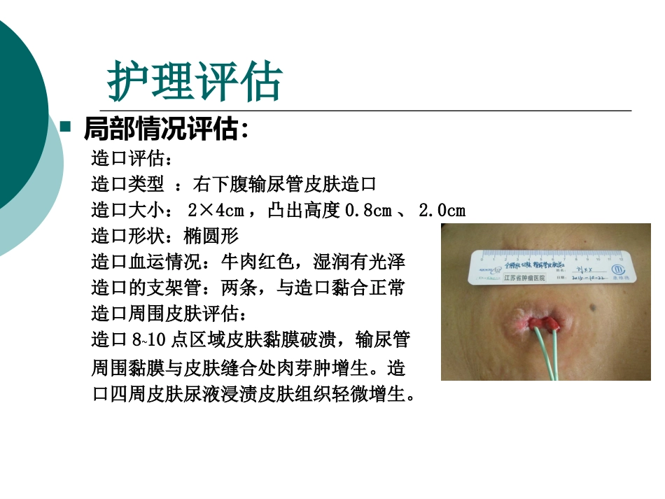 一例输尿管皮肤造口并发刺激性皮炎患者的护理_第5页